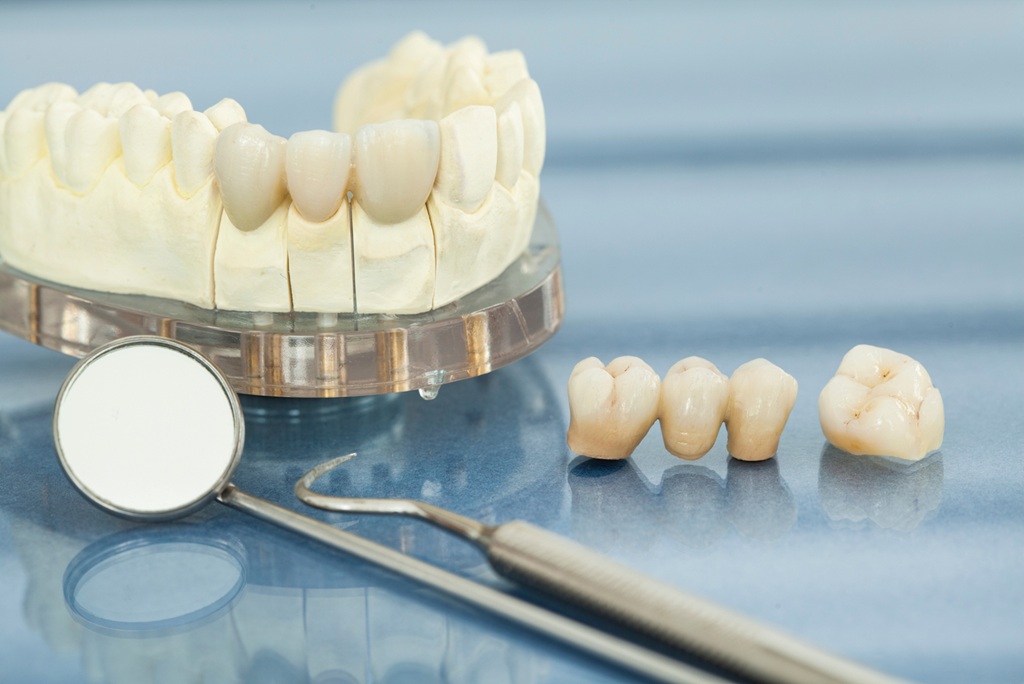 SB Tandartsen - Kroon-Brug-facings-implantaten-Berkel en rodenrijs - Tandarts Berkel