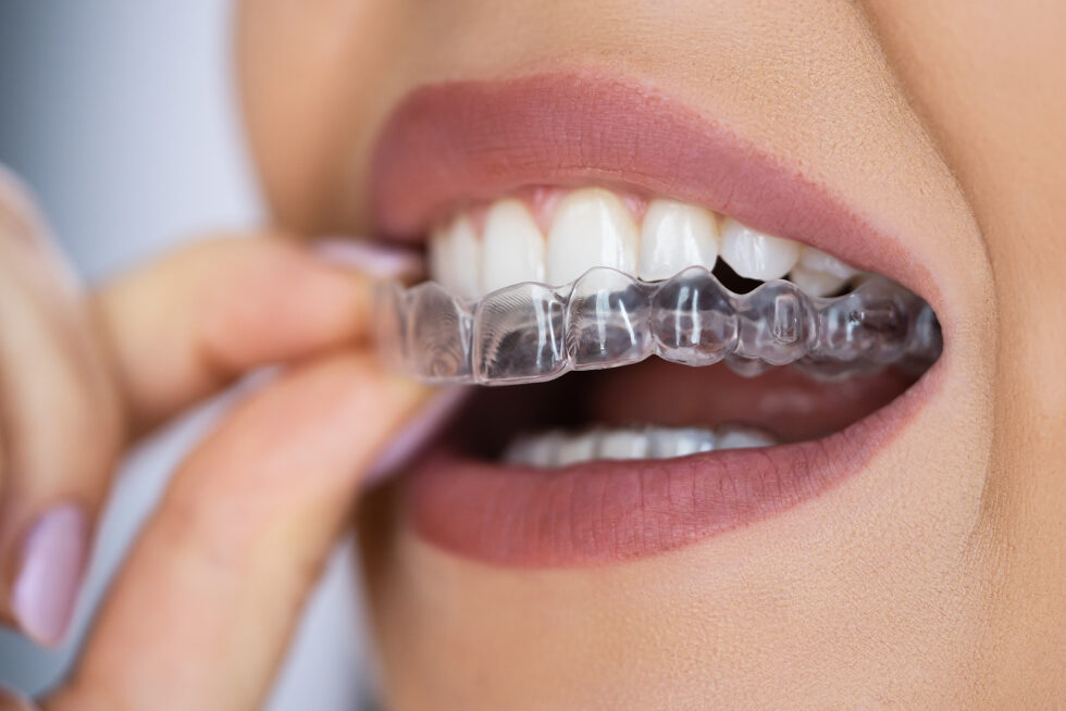 SB Tandartsen Berkel en Rodenrijs - Doorzichtige - ontzichtbare beugel - orthodontist